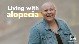 Living with Alopecia: I'm no longer defined as the bald girl with depression.