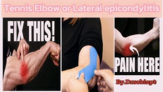 Tennis Elbow Or lateral Epicondylitis and its physical therapy treatment | @drsobiapt