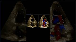 Membrane in LA. Is it partial and non-obstructing Cor Triatriatum Sinister? Any more suggestions.