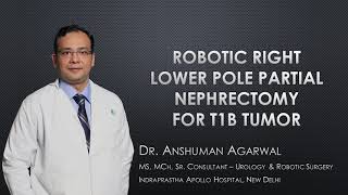 Robotic Right Lower Pole Partial Nephrectomy for T1b Tumor by Dr Anshuman Agarwal, Apollo Hospital