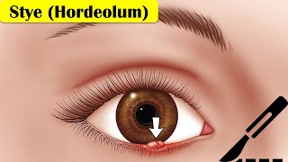 Stye (Hordeolum) - Causes, Pathogenesis, Signs & Symptoms, And Treatment