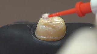 Diş kesimi sonrası anında dentin örtüleme