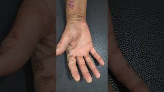 Hand Eczema- treat like a dermatologist @DesignerDoctor #eczema #eczematreatment #shorts #viral