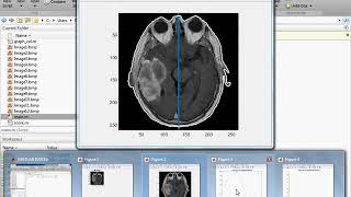 Brain tumor detection in matlab