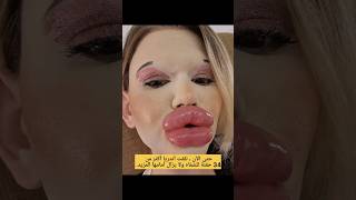 صاحبة اكبر شفاه 👄 في العالم😲لن تصدق كم انفقت على شفتيها