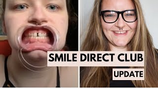 Smile Direct Club 1 Year Update Gap Fix | Brett Larabie