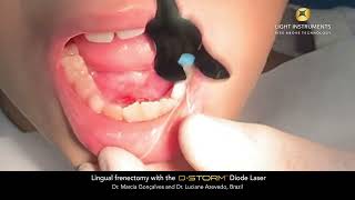 Lingual Frenectomy with the D-Storm™ Diode Laser