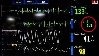 ECG in Pulmonary embolism