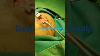 Dermoid cyst scalp with intracranial extension