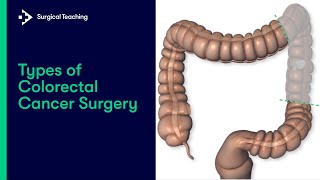 Types of Colorectal Cancer Surgery | What are the Different Operations We Can Perform?