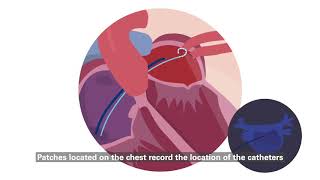 GSAAF Atrial Fibrillation Catheter Ablation