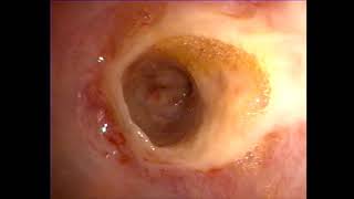 Erosion and ulceration esophagitis