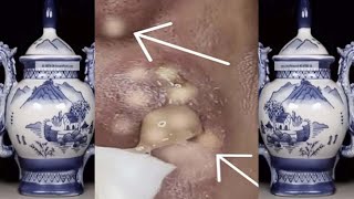 acne tv #031 | Milia, Cystic Acne, Nice pimples & Blackheads Extraction