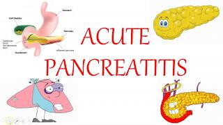 ACUTE PANCREATITIS: Diagnosis , Management, Complications and Scoring Systems #neetpg #aiims #USMLE