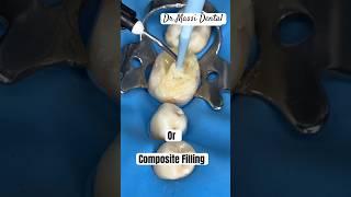 Amalgam filling or Composite filling ?