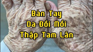 Bí ẩn về người có bàn tay da Đồi Mồi hay còn gọi là bàn tay Thập Tam Lân