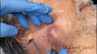 Drainage of an infected cyst along the jaw line