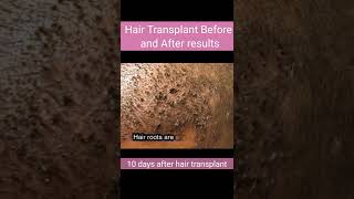 Hair Transplant Before and After results #shorts #hair #transplant #surgery