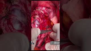 VCİ invaziya etmiş retroperitoneal törəmənin çıxarılması/ Removal of giant retroperitonel tumor