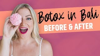 Where to Get BOTOX in Bali: Cocoon Medical Spa (Before and After)