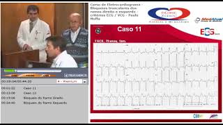 07 Bloqueios tronculares dos ramos direito e esquerdo. Critérios de ECG. VCG