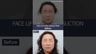 [B&A] Facelift at V.LIF Plastic Surgery Clinic in Korea #shorts