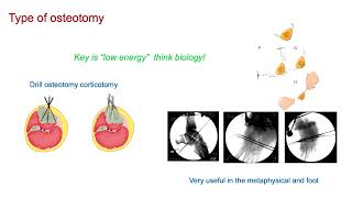 8 principle and planning External fixator assisted internal fixation