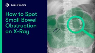 How to Spot Small Bowel Obstruction on X-Ray