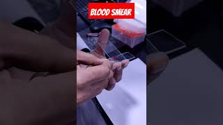 Blood Smear 🩸 #medical #pathology #youtubeshorts #lab #youtube #medicallabtech #ytshort #dmlt #mbbs