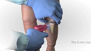 EZ IO Infant Child Needle Selection and Insertion Technique Animation Video