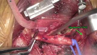 Carotid Endarterectomy (CEA)