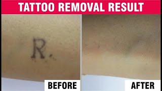 Best Tattoo Removal treatment | tattoo removal specialist | Sakhiya Skin Clinic Review