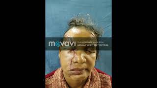 (content warnng:disfigured face)hemifacial laceration injury