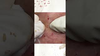 Big Cystic Acne Blackheads Extraction Blackheads & Milia, Whiteheads Removal Pimple Popping