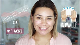 Actualización!! Como Curar el Acné Para Siempre | Lulubella83