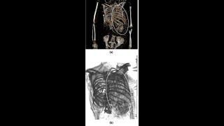 Uno studio sulle mummie dell'antico Egitto identifica la morte per parto