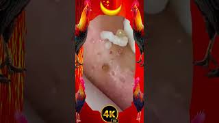 Big Cystic Acne Blackheads Extraction Blackheads & Milia, Whiteheads Removal Pimple Popping #PA181