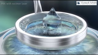 PRK (LASEK) Laser Eye Surgery: Animation high-quality patient education