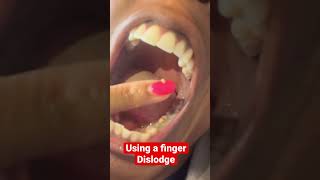 How to remove tonsil stones (tonsiloths)