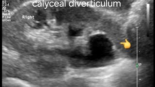 Calyceal Diverticulum: Ultrasound and Color Doppler Findings, Key Differentiation from Calyceal Cyst