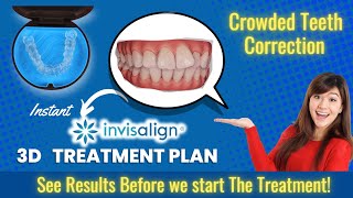 Invisalign ®️ 3D Treatment Plan In Thanjavur |Crowded Teeth correction with aligners|Thanjai dental