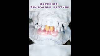 WDC_ANTERIOR REMOVABLE PARTIAL DENTURE #wdc #shorts  #dentist #prosthodontics