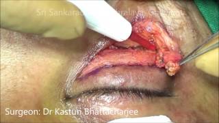 Watch Upper lid Blepharoplasty by Kasturi Bhattacharjee