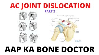 ACROMIOCLAVICULAR JOINT DISLOCATION - PART 1- EPISODE 5