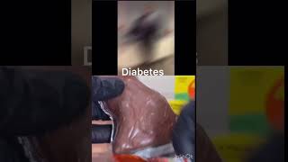 Diabetes meme #shortsfeed #trendingshorts #short