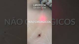 Quer tratar a gordura abdominal em pouco tempo? Conheça a Lipotech! #lipotech #verao2024 #endolift