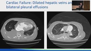 The Liver in Cardiac Disease