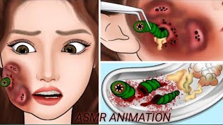 ASMR Strongest Acne,/FacialCleansing /Deep Treatment Part asmr new animation