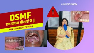 OSMF एक घातक बीमारी है ||