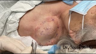 Removal of a large lipoma on the shoulder